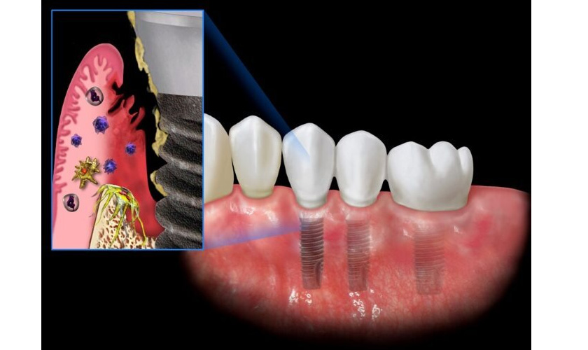 Răng Implant có bị sâu không? Hiểu đúng để phòng ngừa